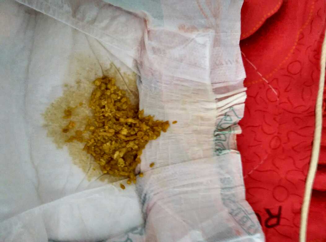 婴儿放屁多拉屎少寻医问药网_宝宝吃药后放屁臭_婴儿吃药后大便次数多