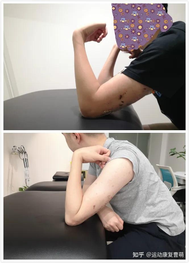 骨折了多久可以恢复_骨折光_骨折的症状
